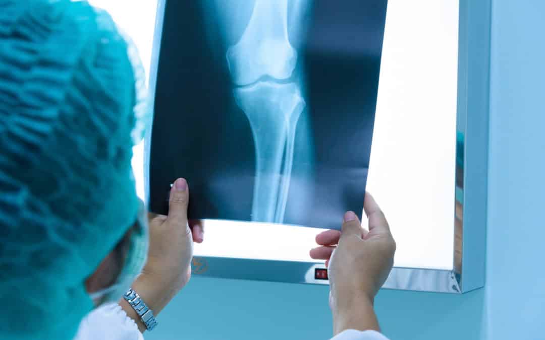 Choice between partial and total knee replacement